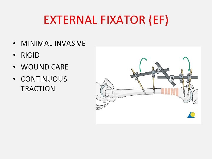 EXTERNAL FIXATOR (EF) • • MINIMAL INVASIVE RIGID WOUND CARE CONTINUOUS TRACTION 