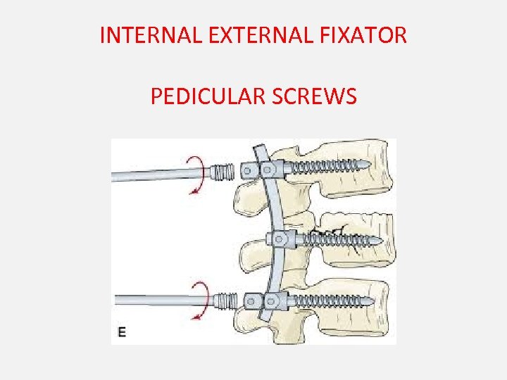 INTERNAL EXTERNAL FIXATOR PEDICULAR SCREWS 