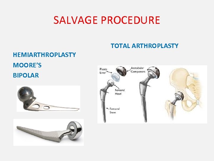 SALVAGE PROCEDURE TOTAL ARTHROPLASTY HEMIARTHROPLASTY MOORE’S BIPOLAR 