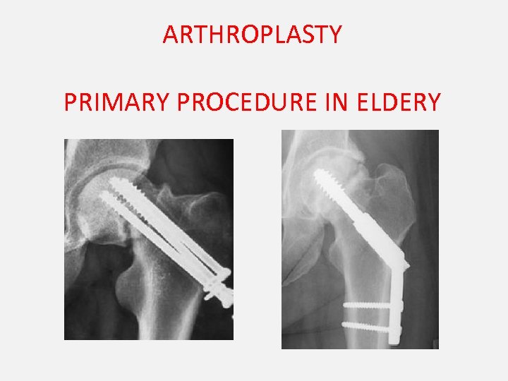 ARTHROPLASTY PRIMARY PROCEDURE IN ELDERY 