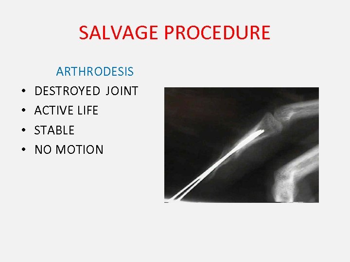 SALVAGE PROCEDURE • • ARTHRODESIS DESTROYED JOINT ACTIVE LIFE STABLE NO MOTION 