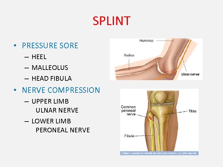 SPLINT • PRESSURE SORE – HEEL – MALLEOLUS – HEAD FIBULA • NERVE COMPRESSION