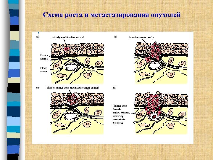 Схема роста и метастазирования опухолей 