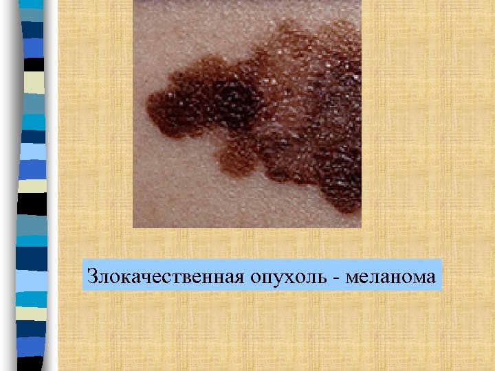 Злокачественная опухоль - меланома 