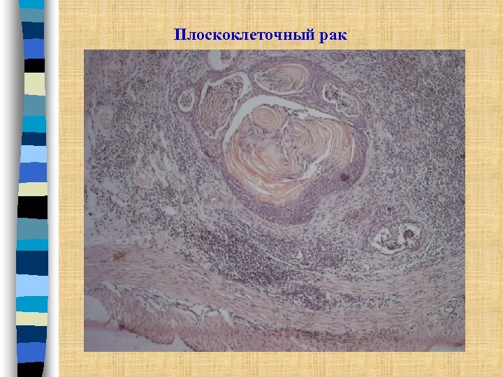Плоскоклеточный рак 