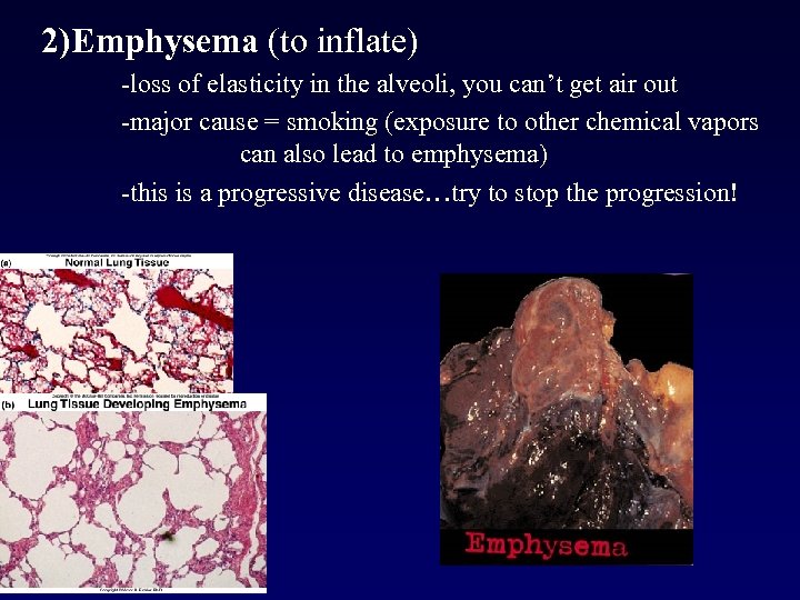 2)Emphysema (to inflate) -loss of elasticity in the alveoli, you can’t get air out