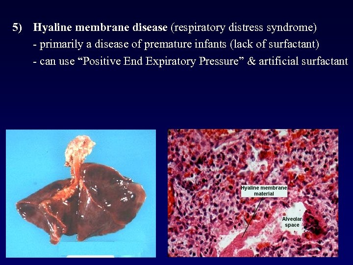 5) Hyaline membrane disease (respiratory distress syndrome) - primarily a disease of premature infants
