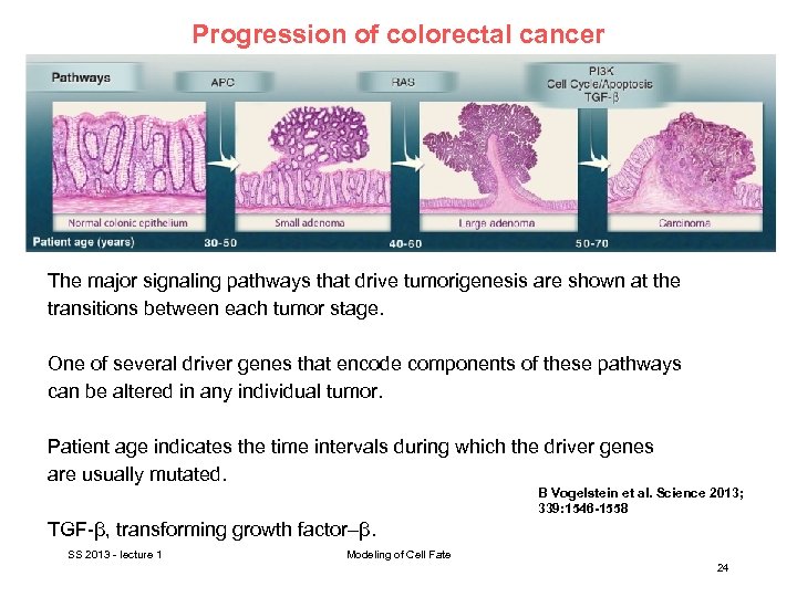 Progression of colorectal cancer The major signaling pathways that drive tumorigenesis are shown at
