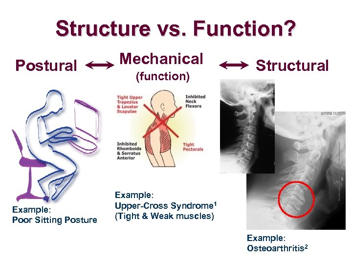 Structure vs. Function? Postural Example: Poor Sitting Posture Mechanical (function) Structural Example: Upper-Cross Syndrome