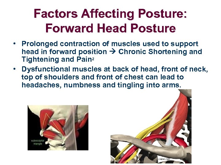 Factors Affecting Posture: Forward Head Posture • Prolonged contraction of muscles used to support