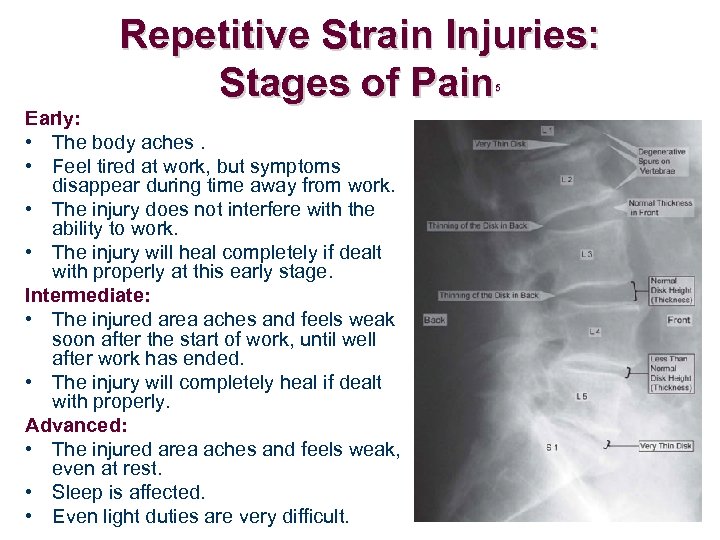 Repetitive Strain Injuries: Stages of Pain 5 Early: • The body aches. • Feel