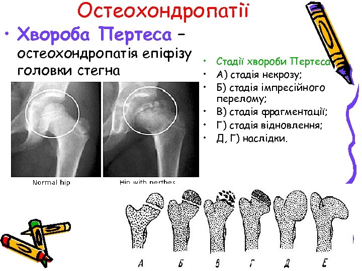 Остеохондропатії • Хвороба Пертеса – остеохондропатія епіфізу головки стегна • Стадії хвороби Пертеса •