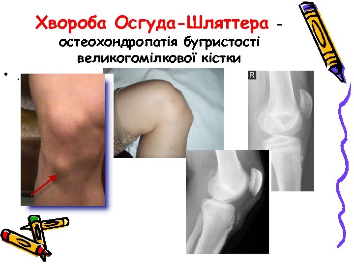 Хвороба Осгуда-Шляттера • . остеохондропатія бугристості великогомілкової кістки - 