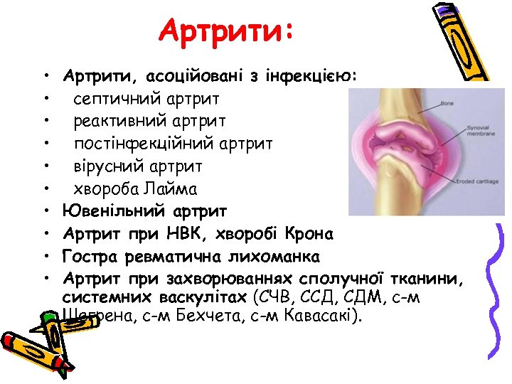 Артрити: • • • Артрити, асоційовані з інфекцією: септичний артрит реактивний артрит постінфекційний артрит