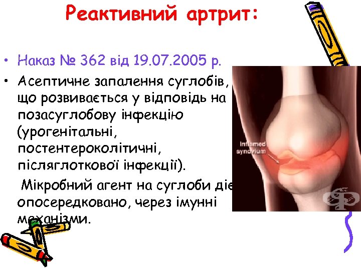 Реактивний артрит: • Наказ № 362 від 19. 07. 2005 р. • Асептичне запалення