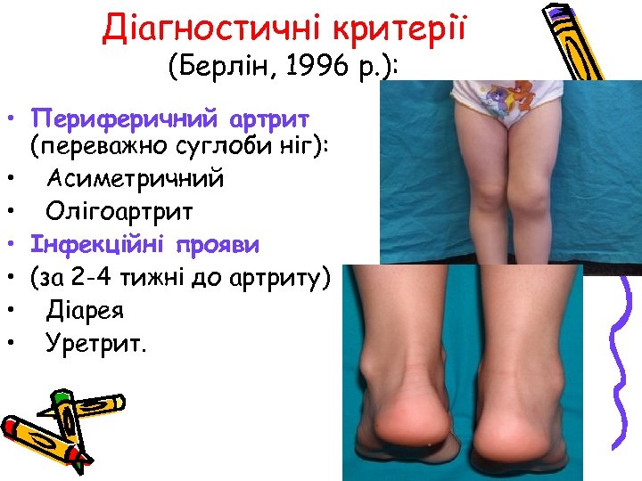 Діагностичні критерії (Берлін, 1996 р. ): • Периферичний артрит (переважно суглоби ніг): • Асиметричний