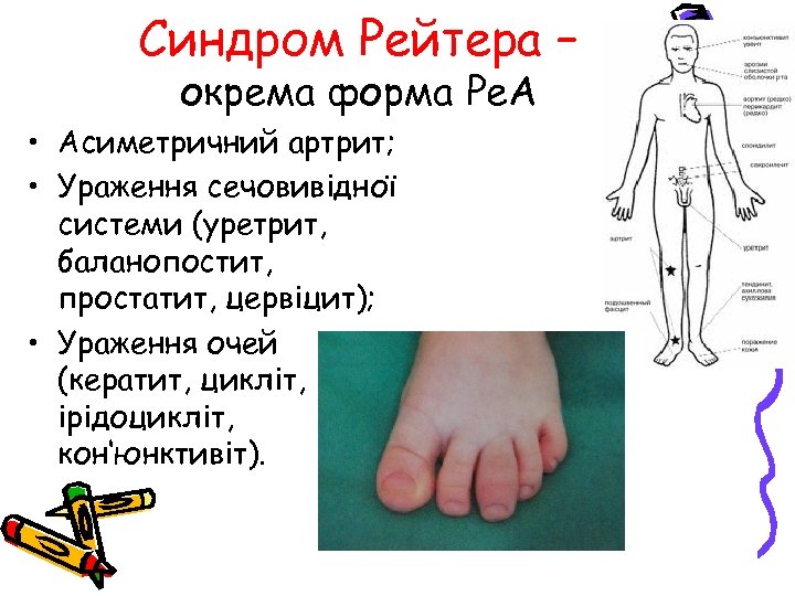 Синдром Рейтера – окрема форма Ре. А • Асиметричний артрит; • Ураження сечовивідної системи