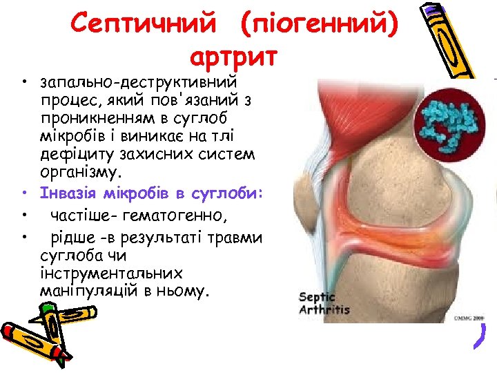 Септичний (піогенний) артрит • запально-деструктивний процес, який пов'язаний з проникненням в суглоб мікробів і