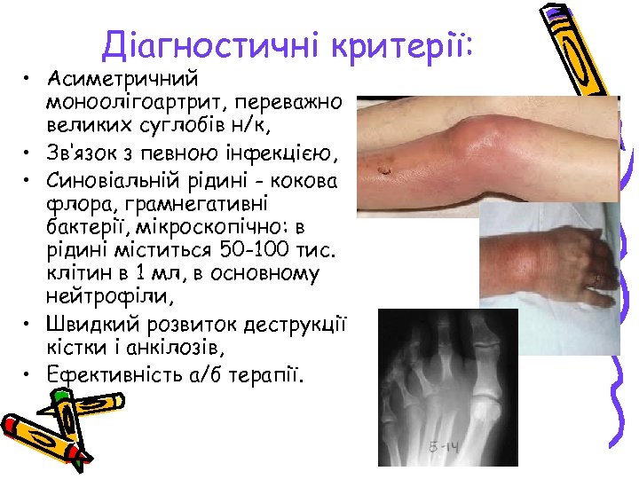 Діагностичні критерії: • Асиметричний моноолігоартрит, переважно великих суглобів н/к, • Зв‘язок з певною інфекцією,
