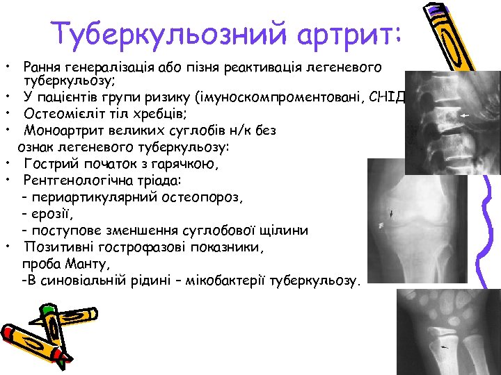 Туберкульозний артрит: • Рання генералізація або пізня реактивація легеневого туберкульозу; • У пацієнтів групи