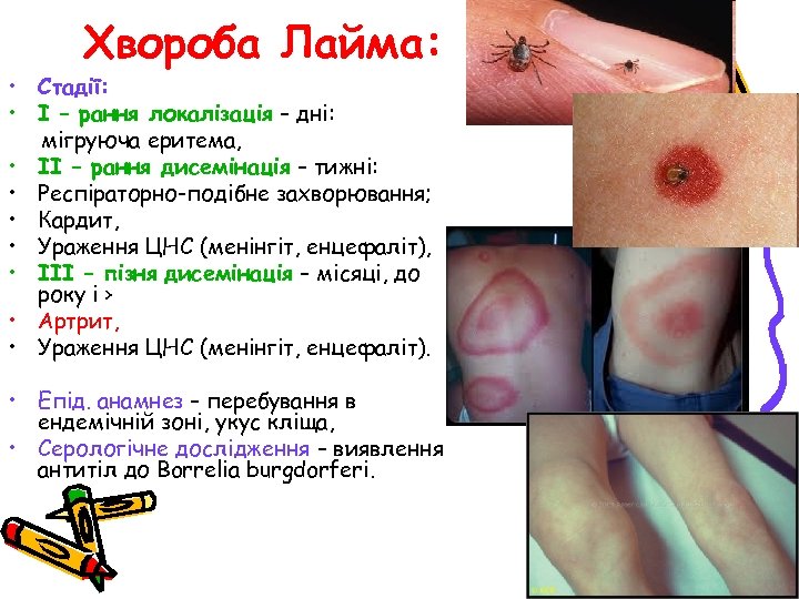 Хвороба Лайма: • Стадії: • І – рання локалізація – дні: мігруюча еритема, •