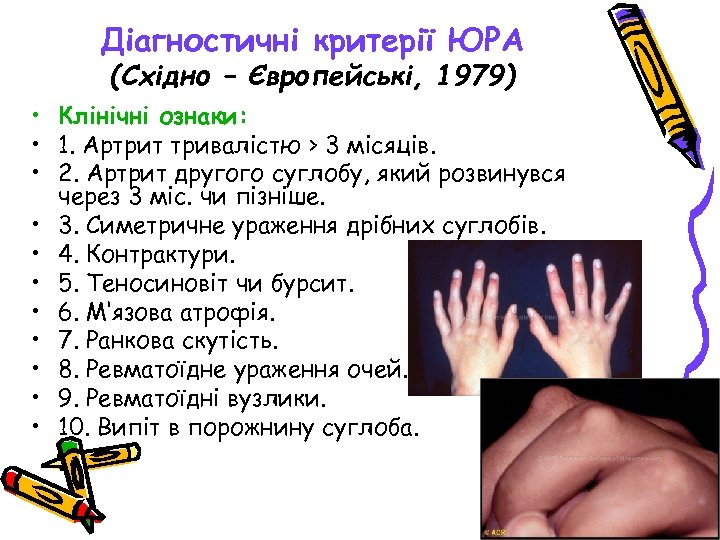 Діагностичні критерії ЮРА (Східно – Європейські, 1979) • Клінічні ознаки: • 1. Артрит тривалістю