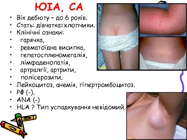  • • • • ЮІА, СА Вік дебюту – до 6 років. Стать: