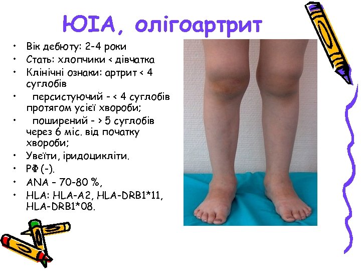 ЮІА, олігоартрит • Вік дебюту: 2 -4 роки • Стать: хлопчики < дівчатка •