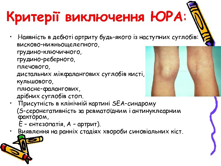 Критерії виключення ЮРА: • Наявність в дебюті артриту будь-якого із наступних суглобів: висково-нижньощелепного, грудино-ключичного,
