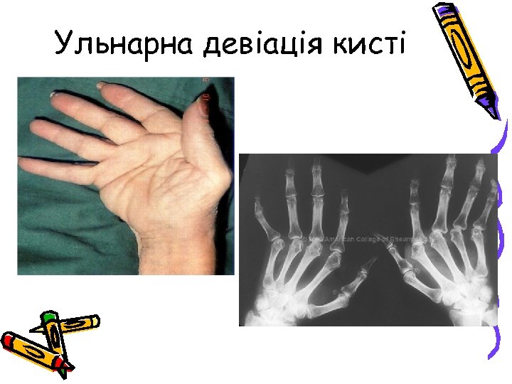 Ульнарна девіація кисті 