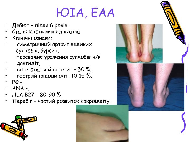 ЮІА, ЕАА • Дебют – після 6 років, • Стать: хлопчики > дівчатка •