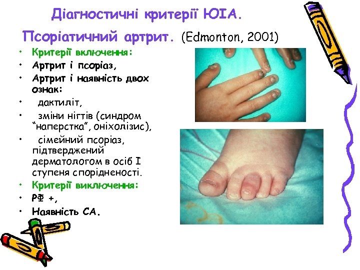 Діагностичні критерії ЮІА. Псоріатичний артрит. (Edmonton, 2001) • Критерії включення: • Артрит і псоріаз,