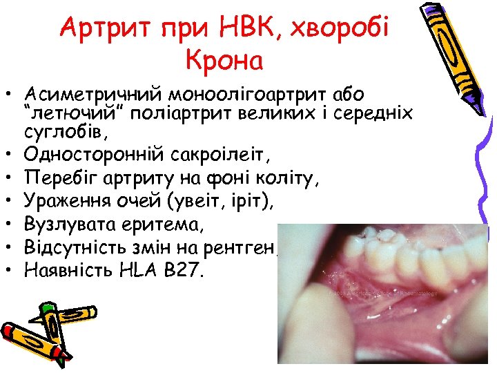 Артрит при НВК, хворобі Крона • Асиметричний моноолігоартрит або “летючий” поліартрит великих і середніх