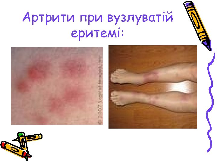 Артрити при вузлуватій еритемі: 