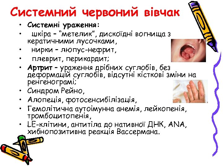 Системний червоний вівчак • Системні ураження: • шкіра – “метелик”, дискоїдні вогнища з кератичними