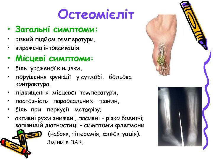 Остеомієліт • Загальні симптоми: • різкий підйом температури, • виражена інтоксикація. • Місцеві симптоми: