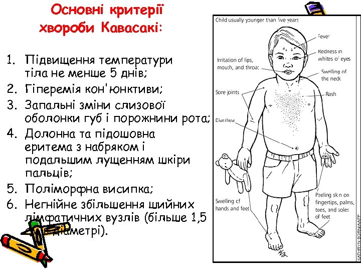 Основні критерії хвороби Кавасакі: 1. Підвищення температури тіла не менше 5 днів; 2. Гіперемія