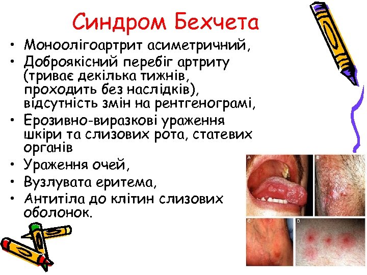 Синдром Бехчета • Моноолігоартрит асиметричний, • Доброякісний перебіг артриту (триває декілька тижнів, проходить без