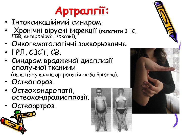 Артралгії: • Інтоксикаційний синдром. • Хронічні вірусні інфекції (гепатити В і С, ЕБВ, ентеровірус,