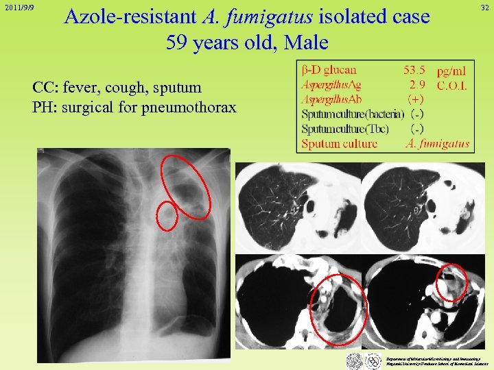 2011/9/9 Azole-resistant A. fumigatus isolated case 59 years old, Male 32 CC: fever, cough,
