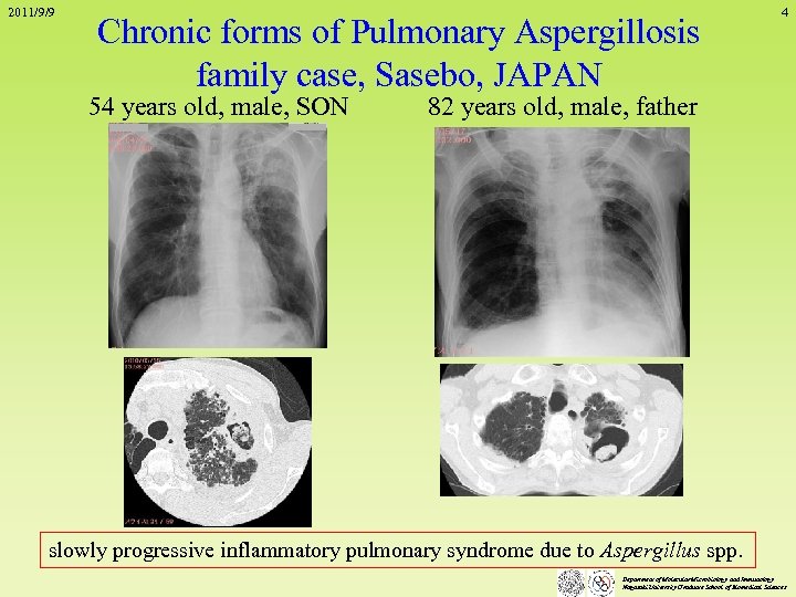 2011/9/9 Chronic forms of Pulmonary Aspergillosis family case, Sasebo, JAPAN 54 years old, male,