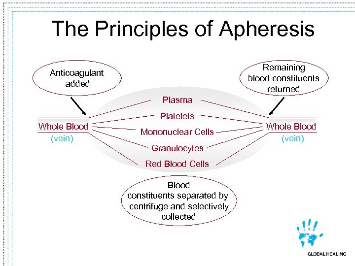 The Principles of Apheresis Remaining blood constituents returned Anticoagulant added Plasma Platelets Whole Blood