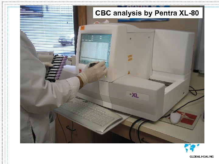 CBC analysis by Pentra XL-80 