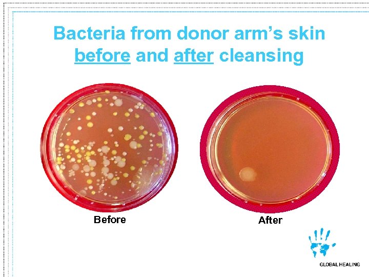 Bacteria from donor arm’s skin before and after cleansing Before After 