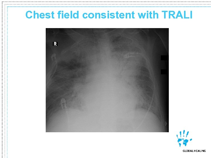 Chest field consistent with TRALI 