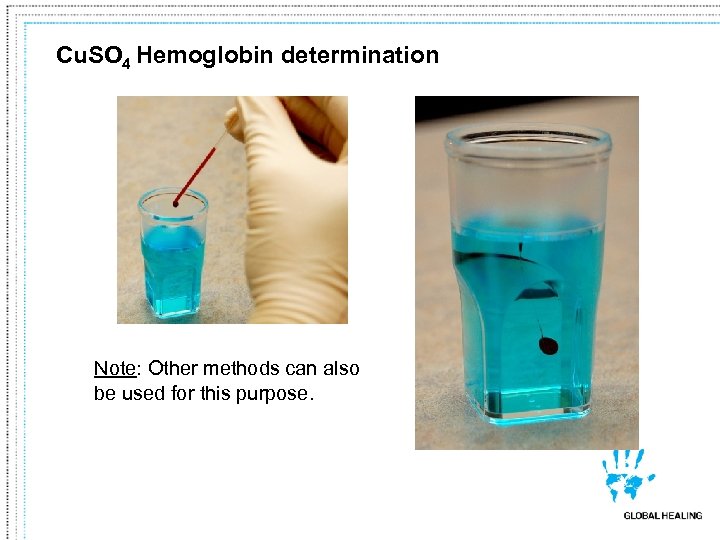 Cu. SO 4 Hemoglobin determination Note: Other methods can also be used for this