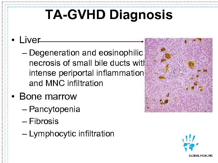 TA-GVHD Diagnosis • Liver – Degeneration and eosinophilic necrosis of small bile ducts with