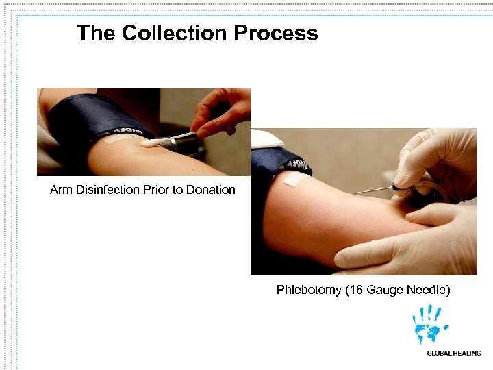 The Collection Process Arm Disinfection Prior to Donation Phlebotomy (16 Gauge Needle) 