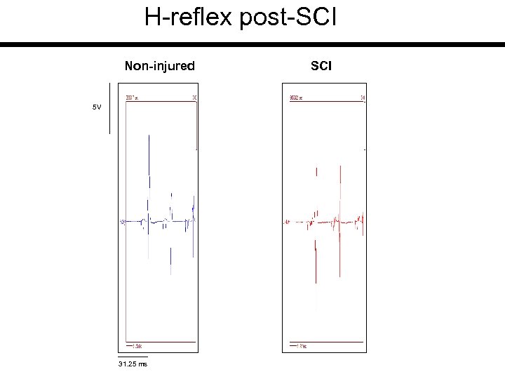 H-reflex post-SCI Non-injured 5 V 31. 25 ms SCI 