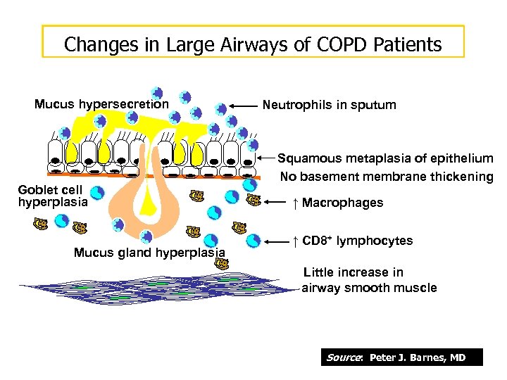Changes in Large Airways of COPD Patients Mucus hypersecretion Goblet cell hyperplasia Mucus gland